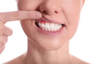 Periodontal Disease