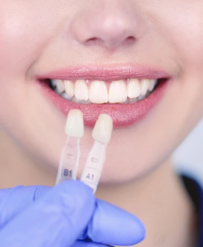 Porcelain Veneers in Manhattan