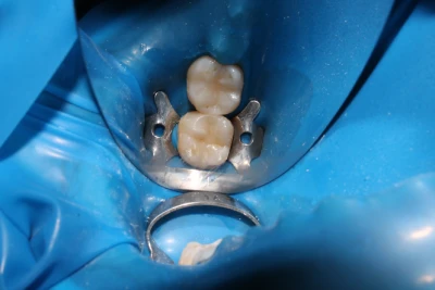 white dental fillings