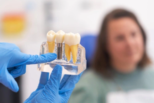 Dental implant model showing implant post and crown used to replace a missing tooth